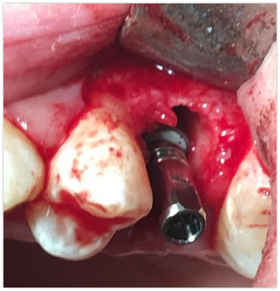 Implantace ihned po vytržení zubu
