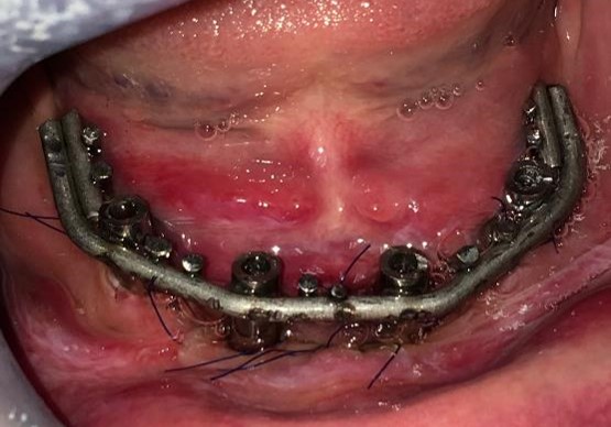 V ústech svařovaná titanová konstrukce na implantátech