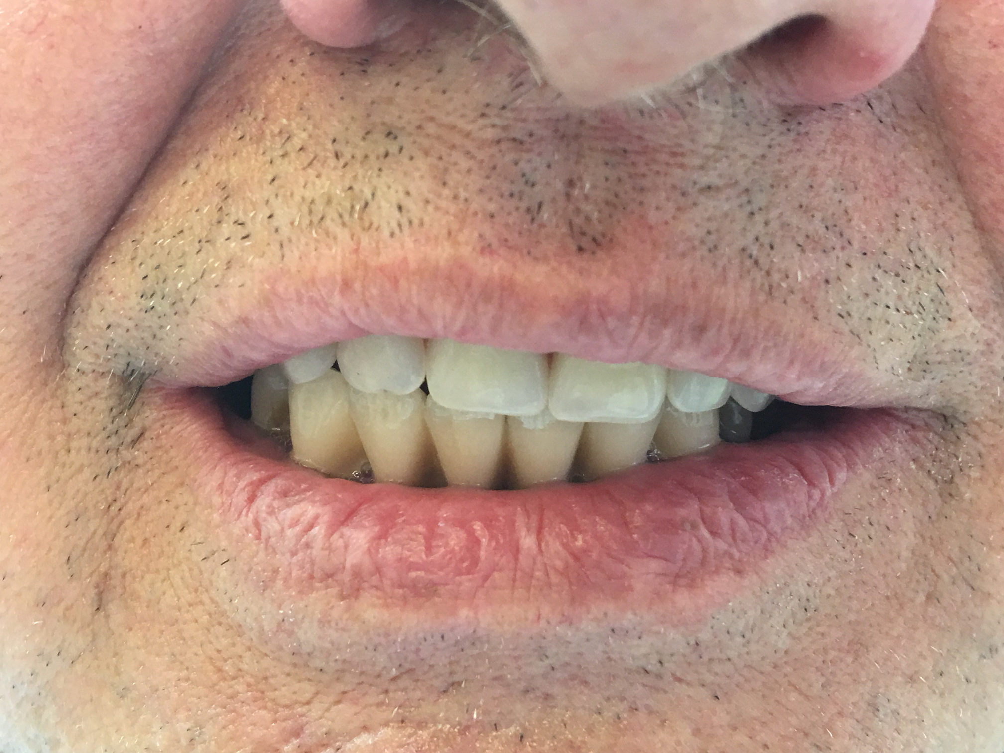 Můstek nesený implantáty v horní čelisti