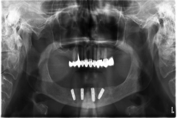 Implantace 4 implantátů v dolní čelisti