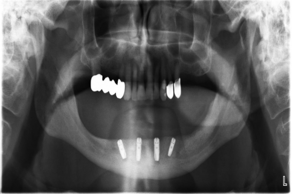 Implantace 4 implantátů v dolní čelisti