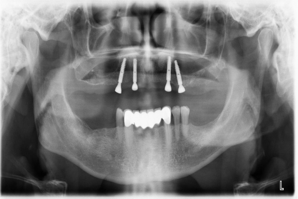 Implantace 4 implantátů v horni čelisti s vhojovacími válečky