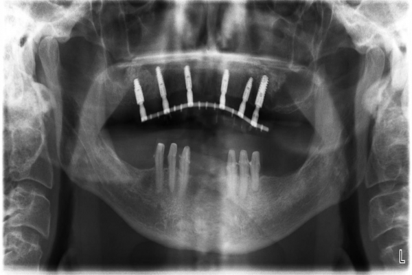 Implantace 6 implantátů v horní čelisti s následně v ústech svařovanou konstrukcí