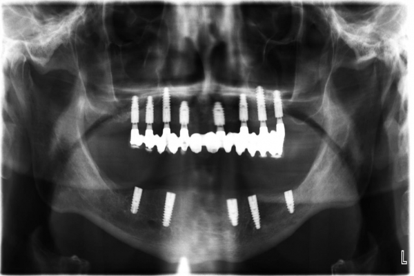 Implantace 8 implantátů v horní čelisti