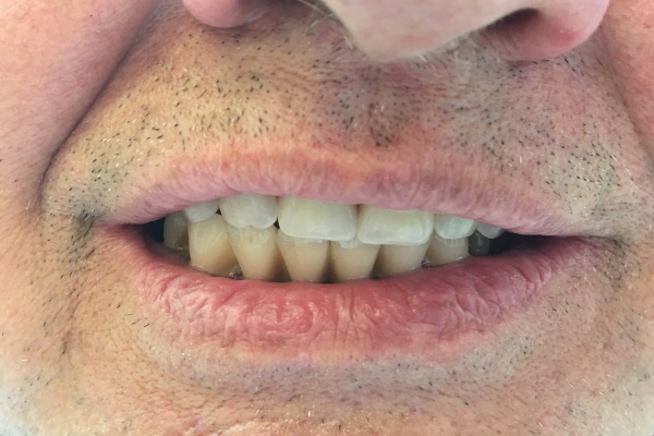 Můstek nesený implantáty v horní čelisti