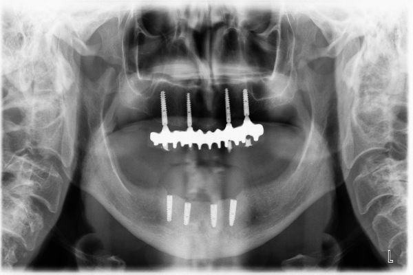 Ošetření v horní i dolní čelisti 4 implantáty